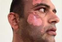 شکارچی صورت محیط‌بان بهشهری را سوزاند +تصویر