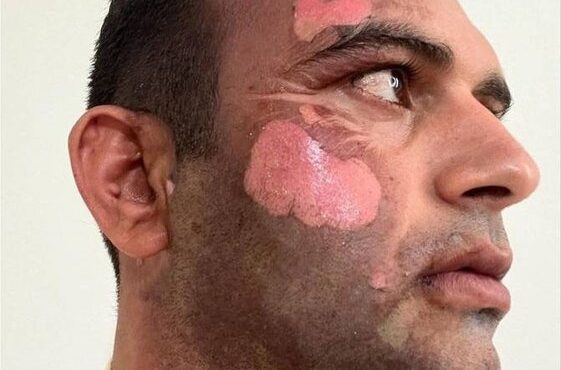 شکارچی صورت محیطبان بهشهری را سوزاند +تصویر شکارچی صورت محیطبان بهشهری را سوزاند +تصویر